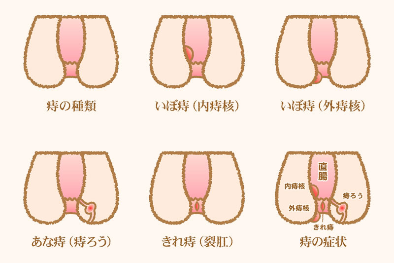 痔の種類